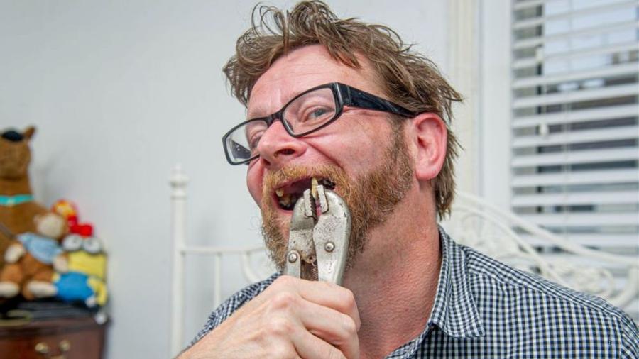 Chris Savage, homem que extraiu dois dentes da própria boca, após não conseguir acesso a um dentista - Reprodução/Solent News