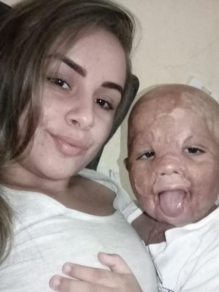 Alice dos Santos Ruiz e o filho, Marcos Levi Ruiz Pontes, que sofreu queimaduras após um acidente doméstico - Acervo pessoal