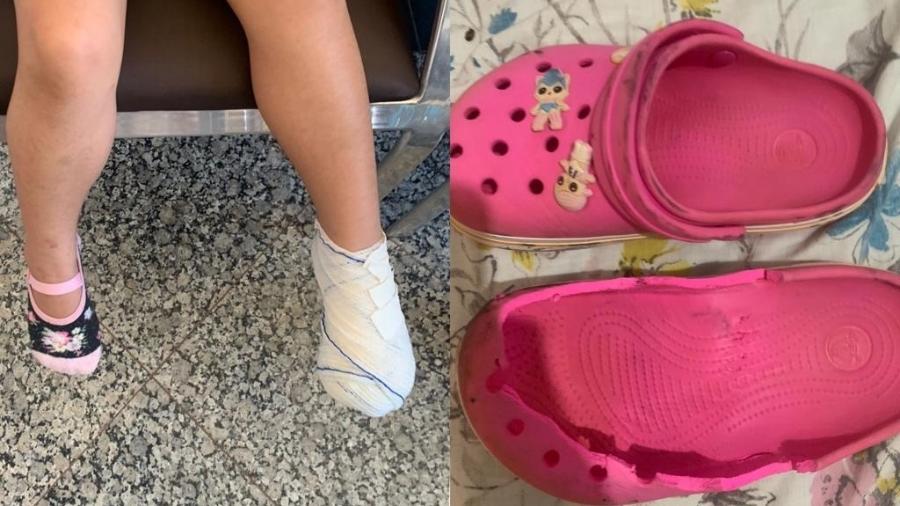 Menina de cinco anos teve dedão do pé amputado após prender membro em escada rolante - Arquivo Pessoal