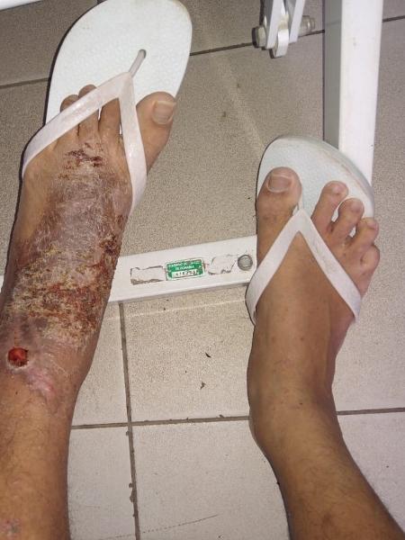 Detento do presídio de Monte Cristo apresenta ferida no pé esquerdo - Defensoria Pública de Roraima