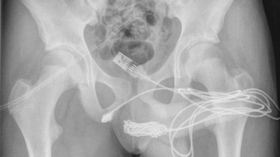 O adolescente foi levado ao hospital após o cabo ficar preso dentro do pênis - Reprodução/Urology Case Reports