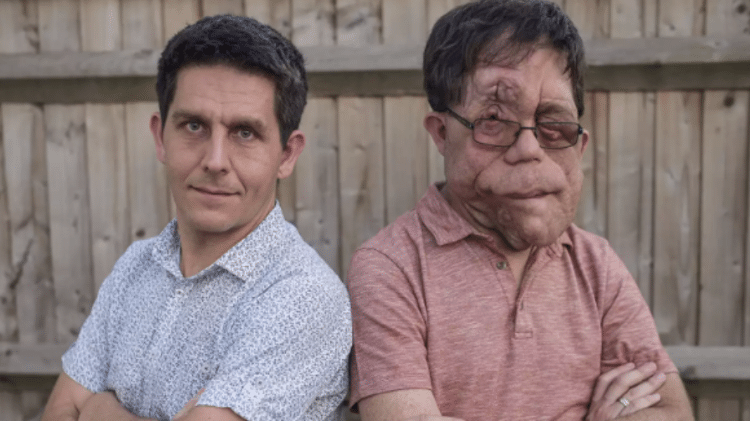 Adam Pearson e irmão gêmeo, Neil, que também tem neurofibromatose, porém não apresenta os mesmos sintomas que o ator