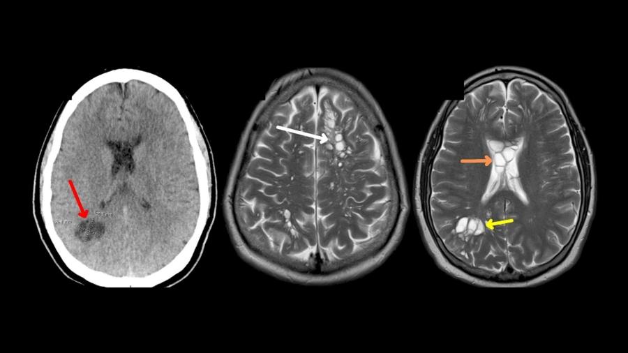 Imagens médicas mostram a localização dos cisticercos no cérebro do paciente