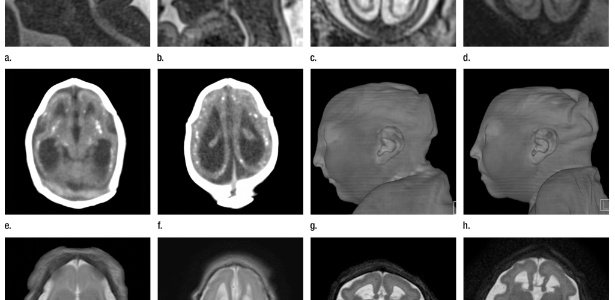 Vírus da zika age no cérebro dos fetos infectados - Radiological Society Of North America via The New York Times