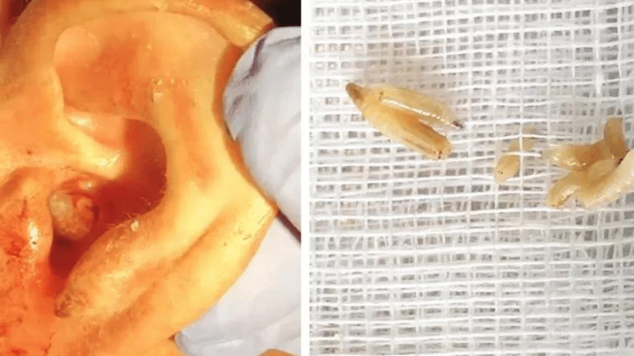 Imagens mostram as larvas no ouvido do português (esquerda) e depois de serem retiradas (direita) - Catarina Rato/New England Journal Of Medicine