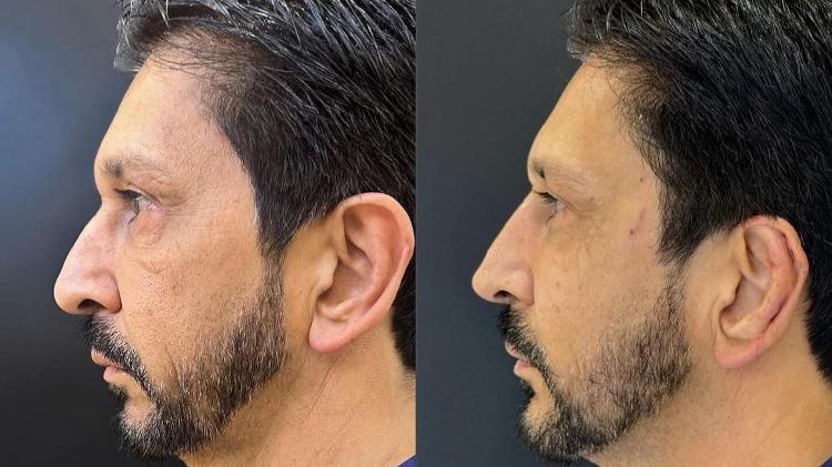 Nunes aplicou botox e fez preenchimento com ácido hialurônico