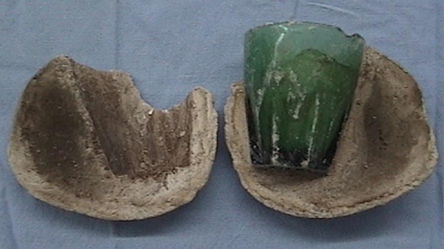 Copo de vidro foi encontrado dentro da bexiga de uma mulher envolto por pedras de 8 cm   - Reprodução/Ahmed Chaabouni