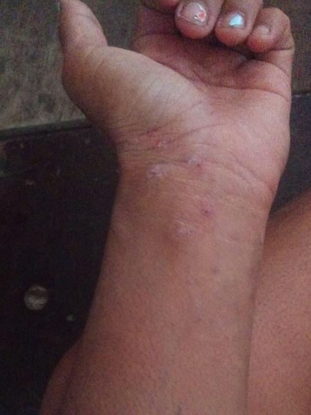 Desempregada, Luara Rodrigues de Oliveira mostra feridas no braço após se contaminar com sarna humana - Arquivo pessoal