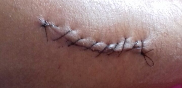 Pontos no braço do adolescente, que por cirurgia após quebrar os cotovelos - Arquivo Pessoal - Arquivo Pessoal