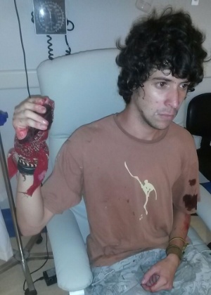 O estudante Gustavo Mascarenhas Camargos Silva, 19, teve o polegar dilacerado por uma bomba atirada por policiais durante a manifestação contra o aumento das passagens em São Paulo - Arquivo pessoal