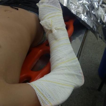 Garoto cai de tobogã, quebra braço e fratura a perna em clube de Planaltina - Arquivo pessoal 