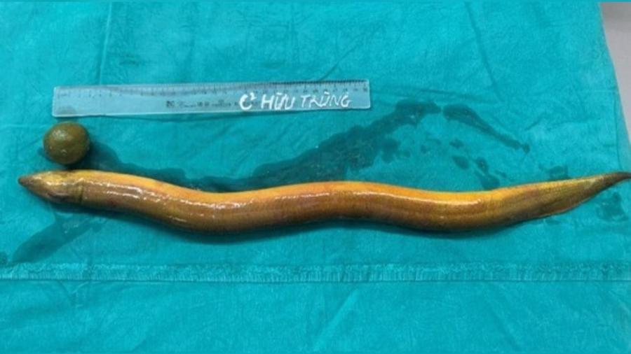 Hospital universitário que fez a cirurgia do homem publicou registro do que foi tirado do intestino dele nas redes sociais