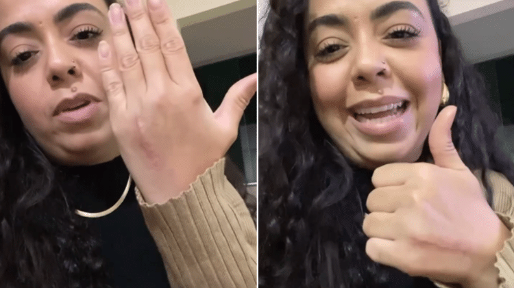 Erica mostra a cicatriz por conta da cirurgia realizada na mão esquerda e garante estar bem Erica mostra a cicatriz por conta da cirurgia realizada na mão esquerda e garante estar bem