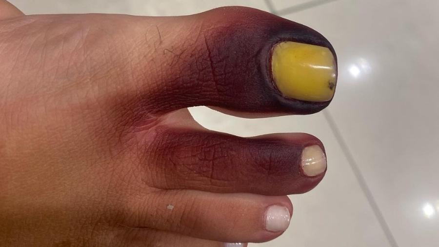 No Rio, Mulher fica com dedo roxo e unha amarela após calçar tênis com piolho-de-cobra - Reprodução/Instagram