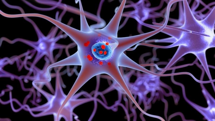 Ilustração mostra neurônios e, dentro deles, em vermelho, depósitos de alfa-sinucleína acumulados; falhas no funcionamento das células em seu início foram detectadas, o que ajuda a explicar o Parkinson - Getty Images