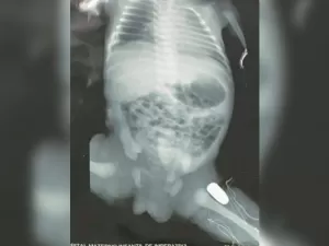 Adolescente grávida é baleada no Maranhão e projétil fica alojado na bebê