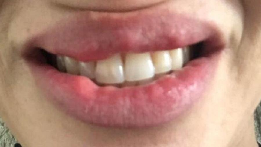 Personal trainer Camilla Carvalho, 35, diz que ficou com a boca deformada após preenchimento labial - Arquivo Pessoal
