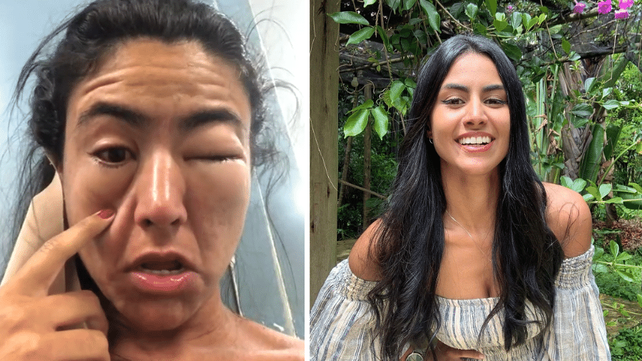 Amanda Nicândio, de 22 anos, teve uma forte reação alérgica a camarão - Arquivo Pessoal