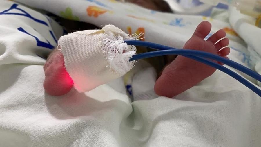 Filhas de Expedito nasceram com 26 semanas, mas se recuperam bem na UTI neonatal - iSEA