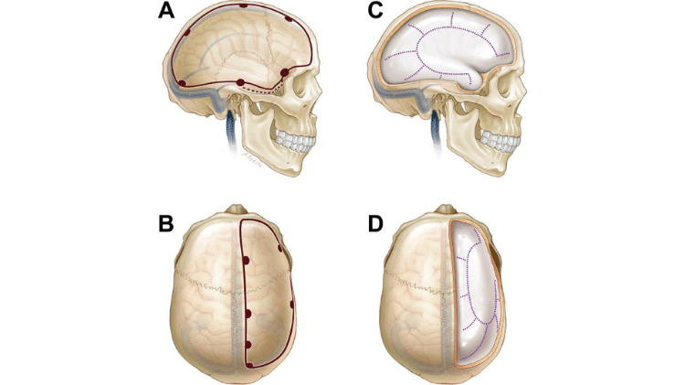 Imagem ilustrativa de craniectomia descompressiva
