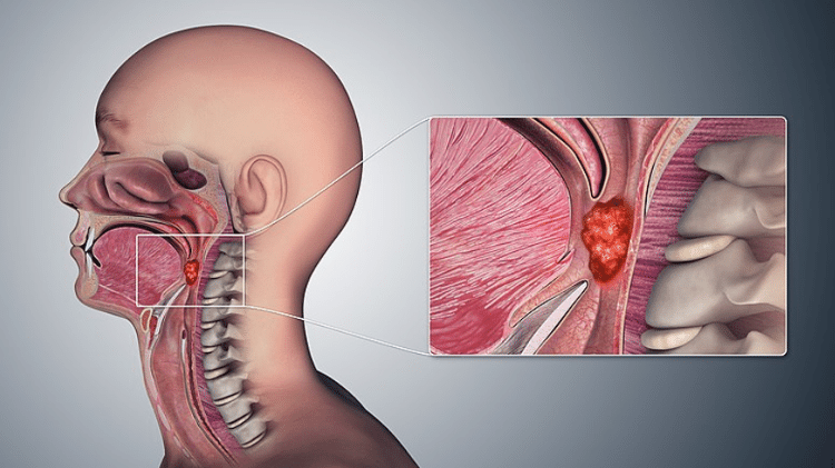 Imagem ilustra tumor na região da orofaringe. Câncer nessa região tem grande relação com a prática de sexo oral