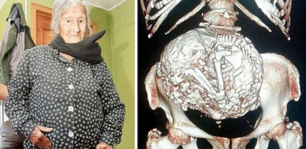  A chilena Estela Meléndez, 92, descobriu que carrega um feto calcificado há mais de 60 anos - BBC