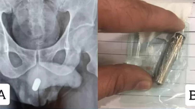 Após passar por cirurgia e precisar de 6 meses para se recuperar, iraniano não contou como a pilha foi parar na sua uretra - Reprodução/Science Direct - Reprodução/Science Direct