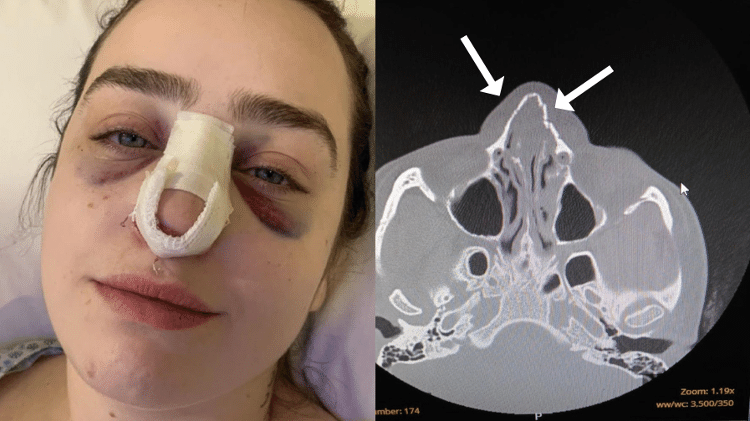Estela Frohlich Bonatto sofreu uma fratura no nariz e afundamento de face 