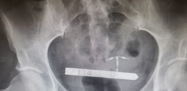 Cerca de 9 cm | Mulher passa por cirurgia após vibrador parar na bexiga
