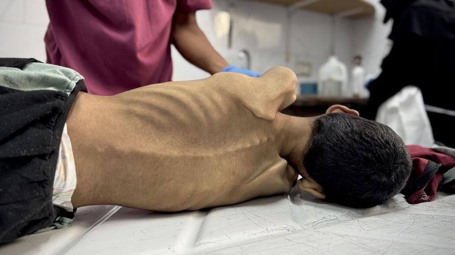 Criança de 14 anos desnutrida em Khan Yunis, em Gaza - Abdallah F.s. Alattar/Anadolu via Getty Images