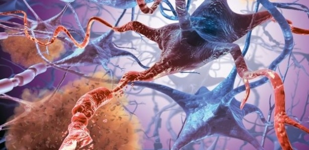 Representação da quebra de conexão entre células cerebrais como acontece em pacientes com Alzheimer - Marc Phares/Science Photo Library