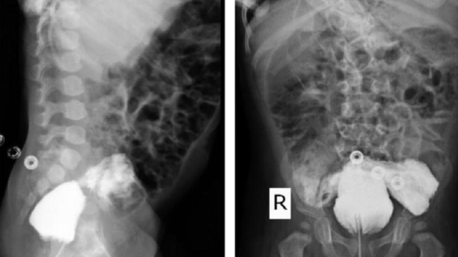 Imagem do exame médico apresenta o sistema urinário da criança, que está conectado diretamente ao reto - Divulgação/Journal Radiology Case Reports