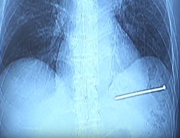 Imagem de raio-x mostra o prego dentro do corpo de Doug Bergeson - Reprodução/YouTube Nathan Oliver
