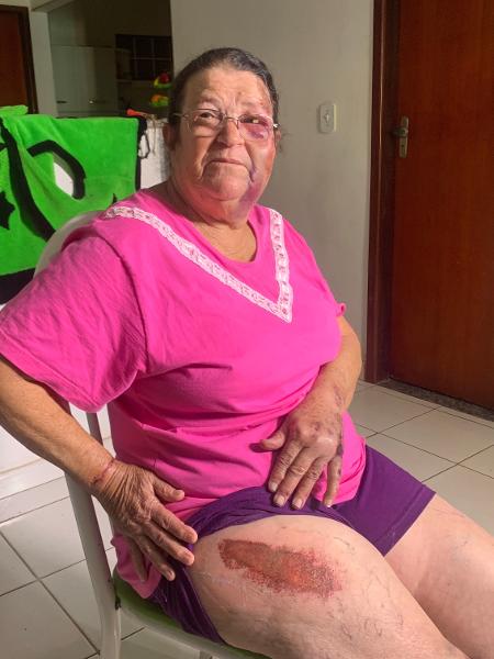 17.jun.2019 - Vendedora de balões Marina Izidoro de Morais, 63, mostra os ferimentos após ser arrastada por um carro no Distrito Federal - Jéssica Nascimento/UOL