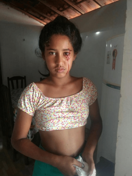 Mikauany Neves, de 12 anos, começou a chorar lágrimas de sangue após dor de cabeça; tomografia não apontou problema - Arquivo Pessoal