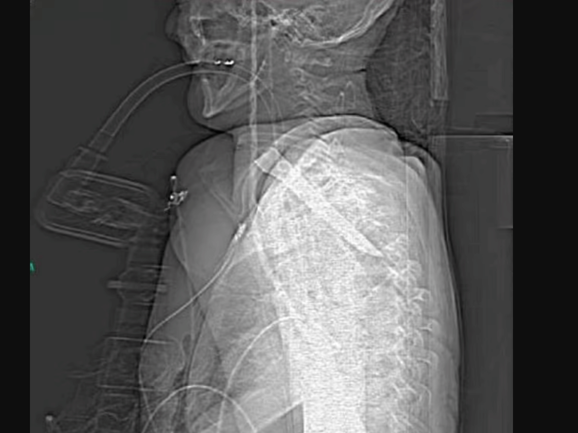 Homem sobrevive com lâmina de 14 cm cravada na garganta