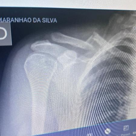 Raio-x de Maryana mostra clavícula quebrada Raio-x de Maryana mostra clavícula quebrada