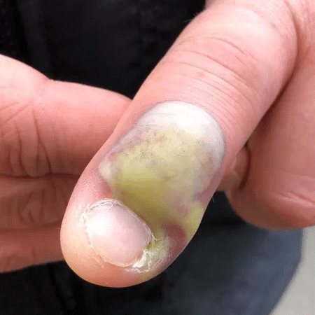 Paciente teve infecção no dedo por roer muito as unhas - Reprodução/Facebook