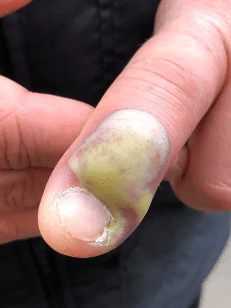 Paciente teve infecção no dedo por roer muito as unhas - Reprodução/Facebook