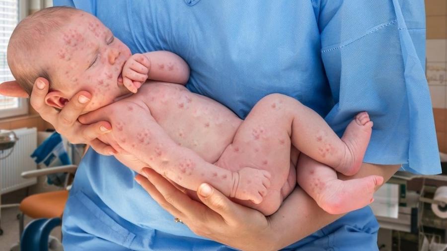 A queda na cobertura vacinal é apontada como causa para surtos de sarampo que têm sido observados em diversos países - Getty Images