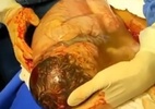 Vídeo: Bebê nasce empelicado e comove equipe médica em GO: 