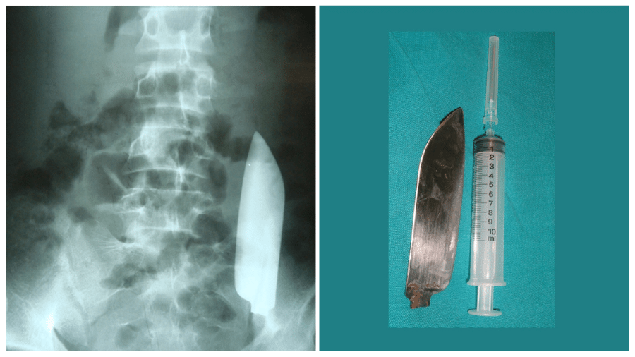 Esquecida no abdome do paciente, a lâmina com 15 centímetros migrou de um lado para o outro, sem causar ferimentos
