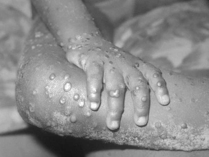 Var&iacute;ola dos macacos: doen&ccedil;a contagiosa rara gera alerta nos EUA