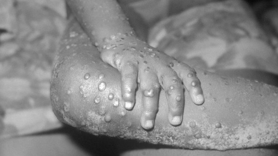 Casos de varíola dos macacos em humanos são extremamente raros - Getty Images