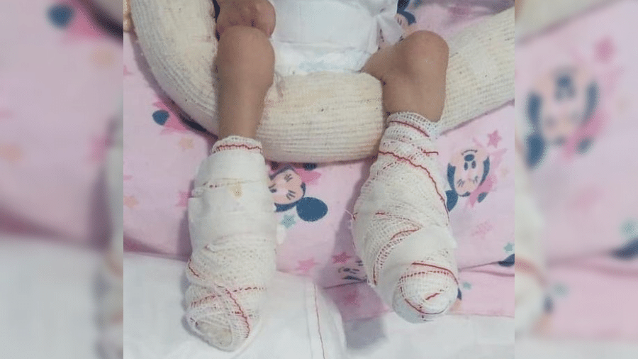 A  criança sofreu queimaduras de segundo grau no pé esquerdo - Reprodução/Redes sociais