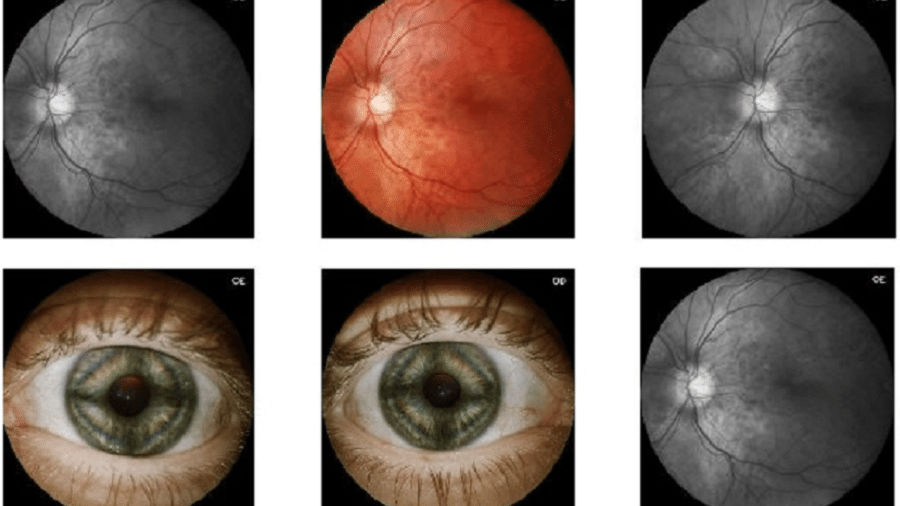 Reconhecimento de Retina - O olho humano