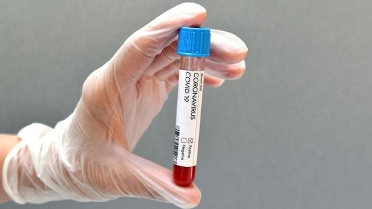 Covid-19: teste pelo ânus, exames rápidos e outros avanços no diagnóstico do coronavírus 22