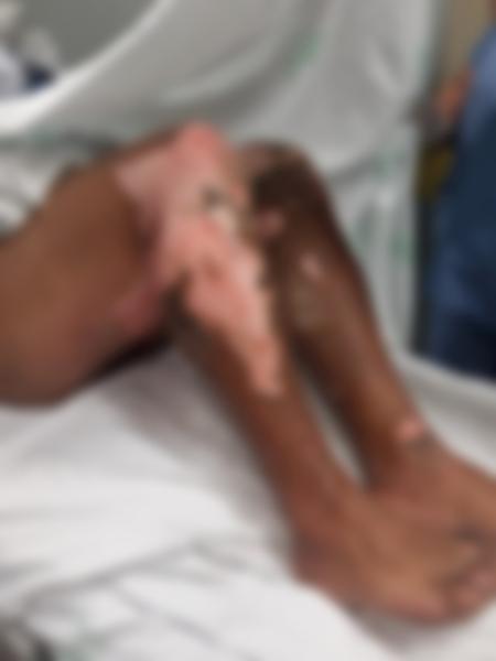 Homem teve as pernas queimadas por grupo de criminosos em Florianópolis - PM/Divulgação