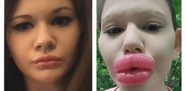 The woman who is proud of the ‘biggest lips in the world’ wants her breasts enlarged