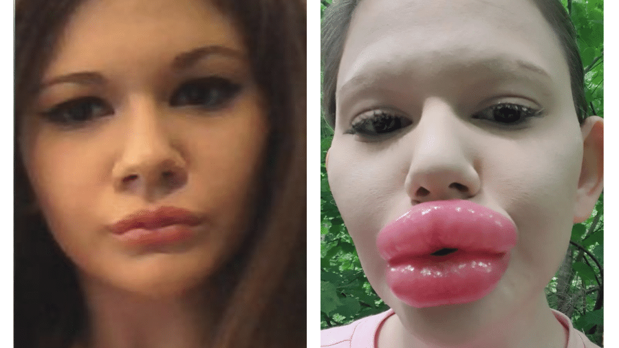 A influencer Andrea Ivanova, 24, antes e depois de ficar conhecida como a mulher com os "maiores lábios do mundo" - Reprodução/Instagram